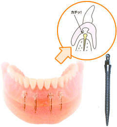 ミニインプラント